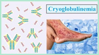 cryoglobulinemia [upl. by Lisa]