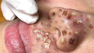 Loan Nguyen Acne spa 44 [upl. by Lilli]