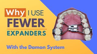 Why I Use Fewer Expanders with the Damon System [upl. by Hernando293]