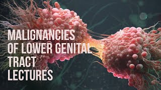 MALIGNANCIES OF LOWER GENITAL TRACT lecture 2 CERVICAL CARCINOMA with all important points [upl. by Aidil]