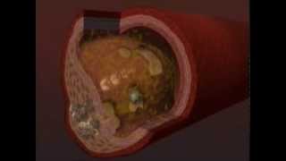 Chelation Therapy Video [upl. by Beverie]