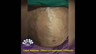 CAPUT MEDUSAE  Dilated Portosystemic collaterals [upl. by Jamin]