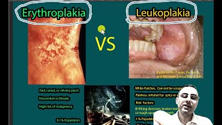 Erythroplakia Vs Leukoplakia Symptoms causes risk of malignancies [upl. by Kcinomod]