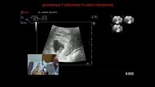 gravidanza alla settima settimana di gestazione [upl. by Kyd]