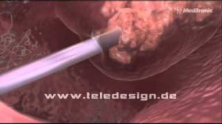 HNO 017 NasenPolypen Entfernung  PAL 169 HNO 017 Removal of nasal polyps  PAL 169 [upl. by Drape]