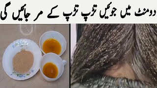 lice removal home remedies  Anti lice treatment at home  lice removal in urdu  lice lice removal [upl. by Clotilde]