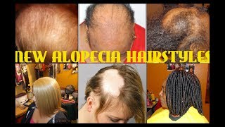 HAVE YOU SEEN THE NEW ALOPECIA HAIRSTYLES HERE ARE SOME BEFORE amp AFTER PHOTOS [upl. by Irakab]