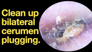 Clean up bilateral cerumen plugging ear wax removal  ear cleaning  ASMR  relaxation  relax [upl. by Idyak]