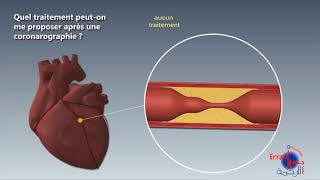 coronarographie [upl. by Neerod658]