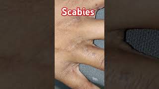 scabies skincare fungaldisease skin diseases [upl. by Amir473]