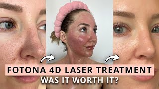 Was the Fotona 4D Laser Treatment Worth It Before amp After [upl. by Eul211]