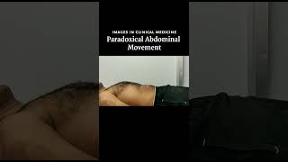 Paradoxical Abdominal Movement  NEJM [upl. by Marigolda722]