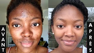 L ACNÉ COMMENT s en DÉBARRASSER 3 PRODUITS contre les boutons et les tâches🔥  SKINCARE ROUTINE💦 [upl. by Michelle]