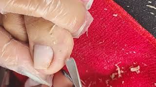 ingrown toenail removal toenail cleaning [upl. by Sikes243]