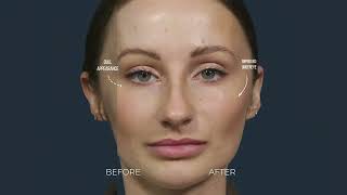 Achieve Perfect Facial Balance with Filler [upl. by Ardnot]