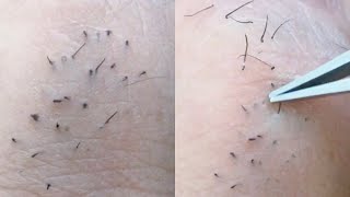 Ingrown hair removal satisfying [upl. by Xuerd]