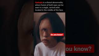 what is cyclopia  a single eye facts medical genetics shorts [upl. by Eusadnilem581]