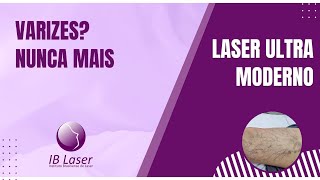 Tratamento de varizes a laser [upl. by Eessac]