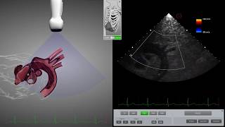 HeartWorks Aortic Dissection [upl. by Morrissey]