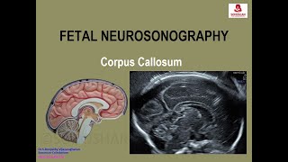 Fetal Neurosonography – Corpus Callosum [upl. by Joey374]