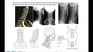 Radiographies du rachis cervical [upl. by Assirol]