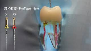 Shaping mb1 ProTaper Next [upl. by Siramay]