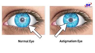 O que é Astigmatismo [upl. by Meekar374]