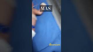 MAS Meconium Aspirated Syndrome meconium syndrome aspiration ytshorts ytfeed nursingofficer [upl. by Stenger]