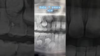 Baby teeth tooth babytooth babyteeth xray dentist orthodontist dentaloffice dentalassistant [upl. by Aileda82]