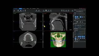 Romexis 61 CBCT OverView [upl. by Julius]