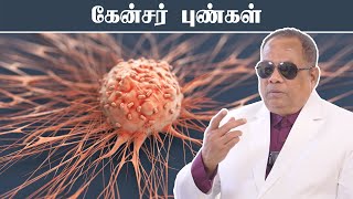 கேன்சர் புண்கள்  Cancerous lesions [upl. by Nnaeitak]