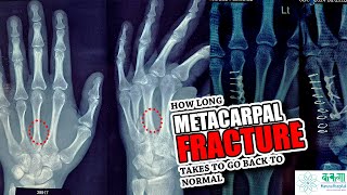 Metacarpal shaft fracture recovery story fracture metacarpal injury [upl. by Eyak501]