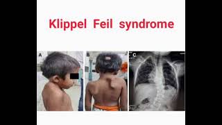 Klippel feil syndrome mrcpch Clinical [upl. by Evvy]