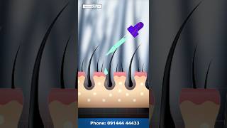 PRP  Best Hair Loss Treatment  Derma Roller vs PRP For Hair Loss Treatment shorts prp [upl. by Nelav]