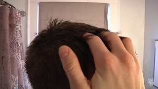 Mayo Clinic Minute Tips for dealing with dandruff [upl. by Jacobsohn236]