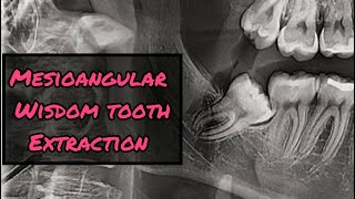 Mesioangular Wisdom Tooth Extraction StepbyStep [upl. by Yaner]