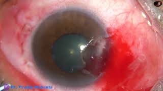 Pterygium surgery with conjunctival autograft using fresh blood as glue  PM 2442019 [upl. by Bathulda]