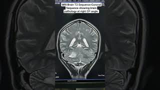 MRI Brain T2 Sequence Coronal Section anatomy beginners medicalimaging radiology mri diagnosis [upl. by Bayard]