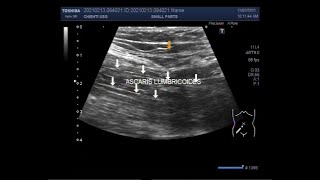 Intestinal worm Infestation by Ascaris lumbricoides [upl. by Remot]