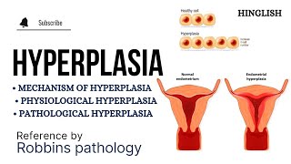 Hyperplasia  Cellular Adaptation  BPH  Pathology [upl. by Gianina]