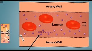 Cholesterol Particle Counts and Heart Disease  Put into Context ApoB LDLp [upl. by Suzann]