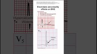 Electrolyte abnormality effects on EKG [upl. by Him515]