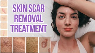 All about Facial Scar and Skin Scar Removal Treatment [upl. by Schild682]