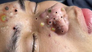 loan nguyen acne amp spa 252 [upl. by Brinna]