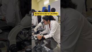 Adenocarcinoma of Gallbladder cancer breastcancer mbbs mbbsstudentlife mbbsadmission2024 [upl. by Ahsenat]