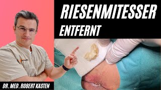 RIESENKOMEDO in der Leiste entfernt Hautarzt kann es kaum fassen Mitesser pimple giant comedone [upl. by Onitnelav]