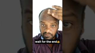 👴🏼👱‍♂️ வாழ்ந்தான் டா மாதிரி வாழனும் My Transformation hairtransplant haircare transformation [upl. by Brittney]