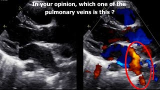 quot Pulmonary Veinsquot All Echo Views [upl. by Akinnor611]