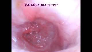 👂Ear drum on Valsalva maneuver [upl. by Nachison]