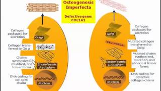 osteogenesis imperfecta  genetic defects [upl. by Nolrac]